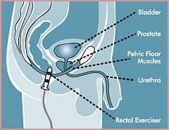 Electrical Stimulation For The Pelvic Floor - Incontinence & Prolapse